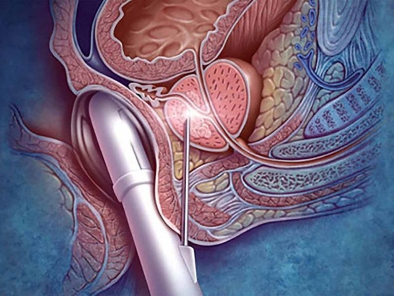 Prostat Biyopsisi Nasıl Yapılır?
