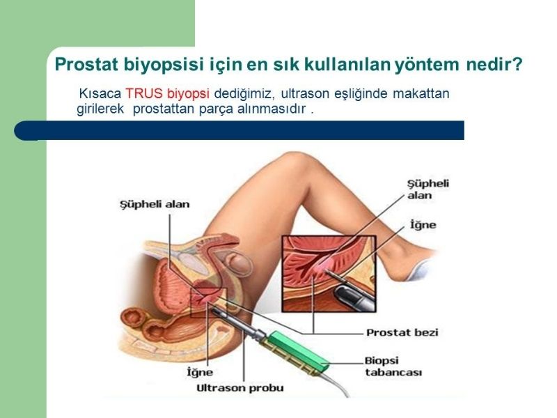 Prostat Biyopsisi Nedir?